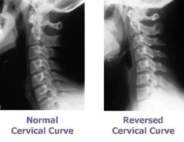 Two X-rays of the cervical spine shown side-by-side comparing a normal cervical curve with a reversed cervical curve
