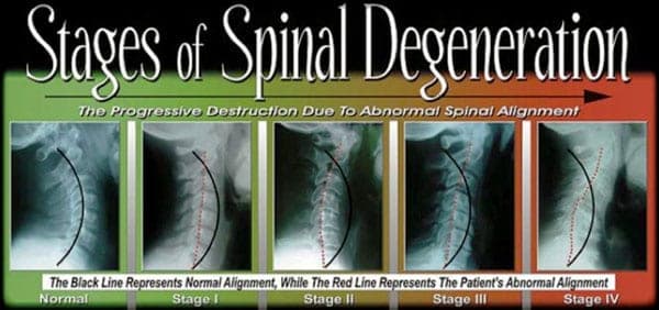 The Stages Or Phases Of Spinal Decay