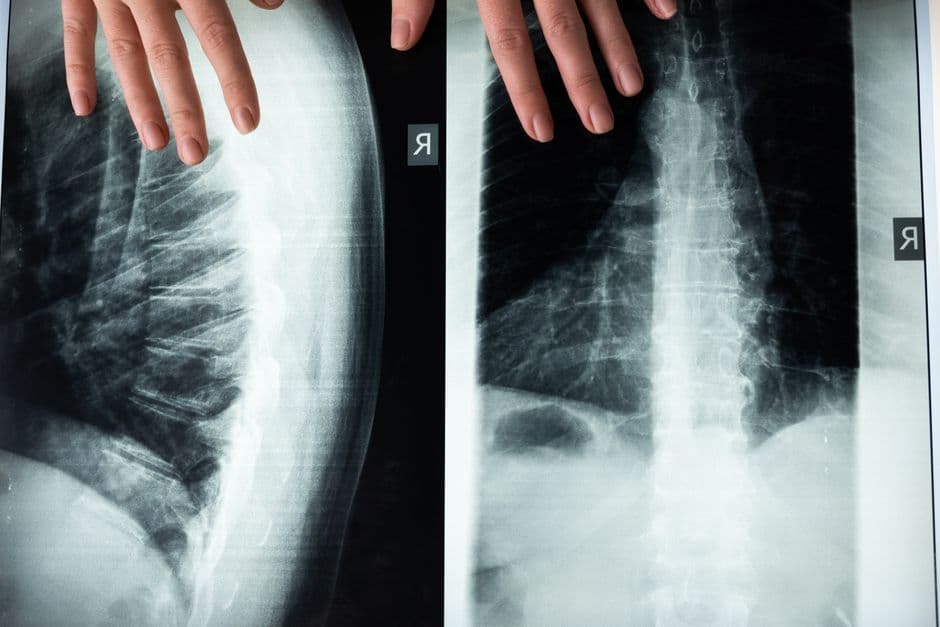 Thoracic Hyper Kyphosis